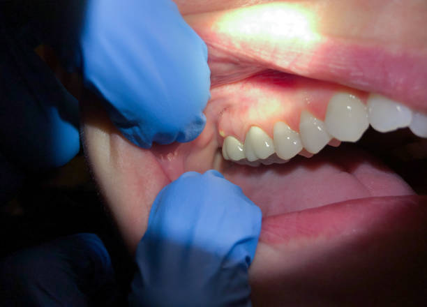 Best Emergency Dental Care for Abscessed Tooth in Hurst, TX